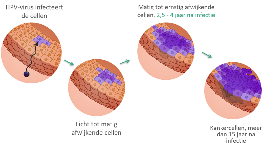 het ontstaan van baarmoederhalskanker visueel uitgebeeld